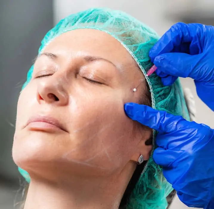 Thread lift treatment in delhi